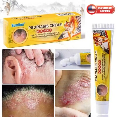 #ad Health Care Psoriasis Cream Eczema Ointment Scalp Psoriasis Hand Tinea Foot 癣霸 $9.95